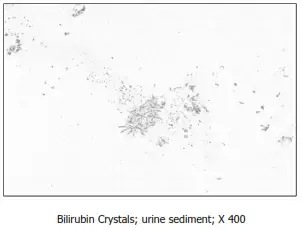 Cristaux de bilirubine